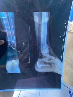 Patient’s x-ray result, about to be amputated in a government hospital, now he walks very sound